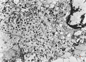 M, 63y. | suprarenal neuroblastoma M, 63y. | suprarenal neuroblastoma